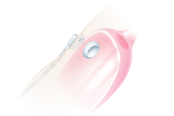 HpBio PEG Gastro Cirurgia