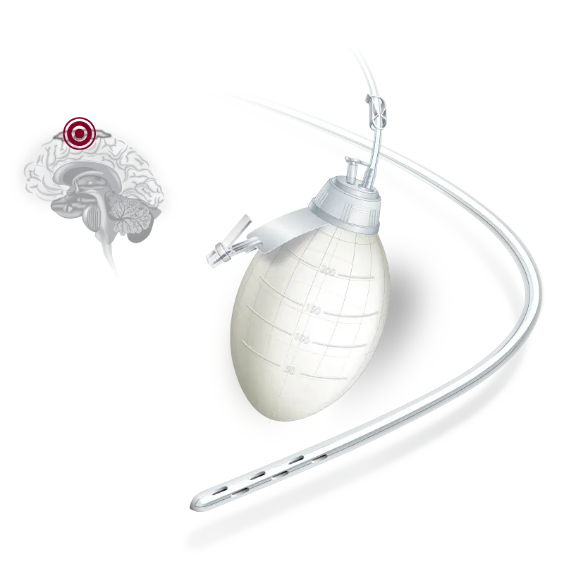 Derivação Hematoma Subdural
