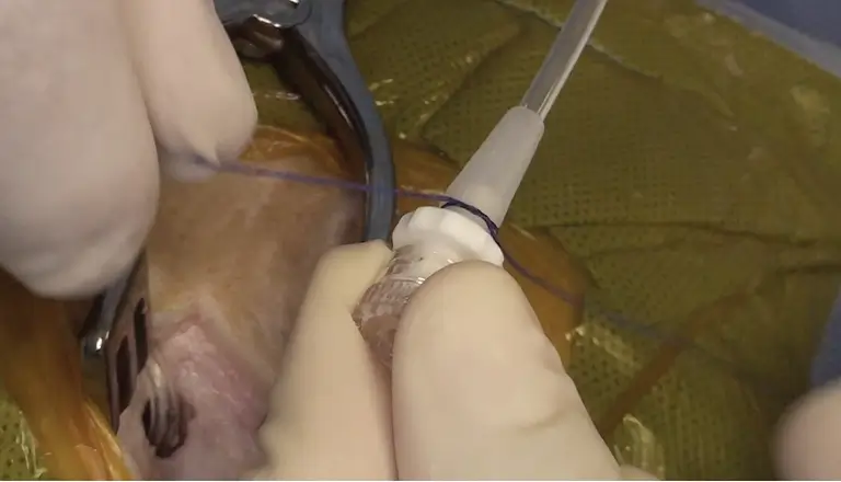 EXTERNAL VENTRICULAR DRAINAGE 