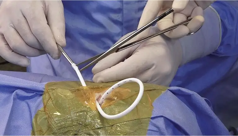 PIC VENTRICULAR HEMORRÁGICO