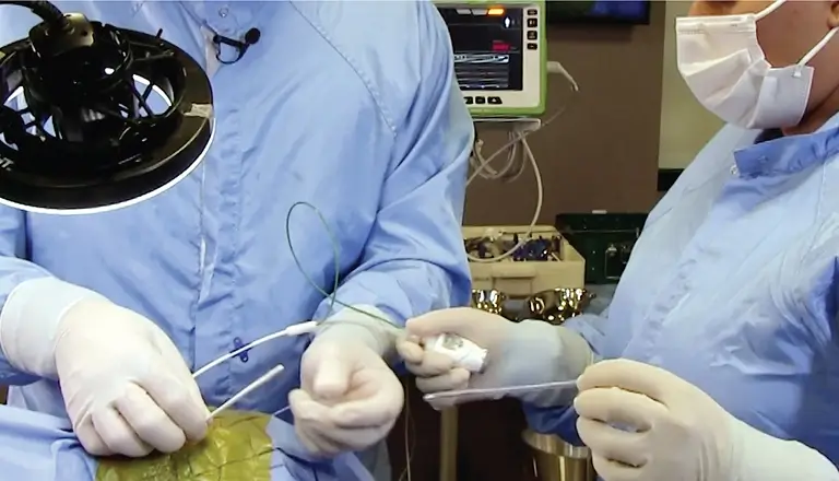 VENTRICULAR ICP CATHETER