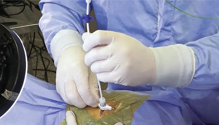 VENTRICULAR ICP CATHETER